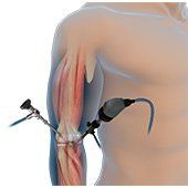 Elbow Arthroscopy 