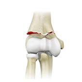 Elbow Fractures