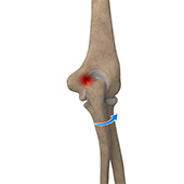 Elbow Impingement