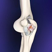 Elbow Ligament Reconstruction