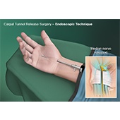 Endoscopic Carpal Tunnel Surgery