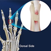 Extensor Tendon Injuries