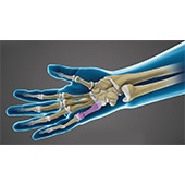 Fractures of the Hand and Fingers