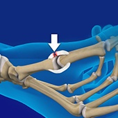 Gamekeeper’s Thumb