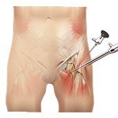 Hip Arthroscopy