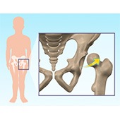Hip Dysplasia