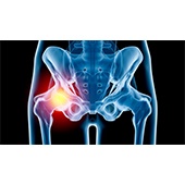 Hip Injury