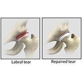Hip Labral Repair