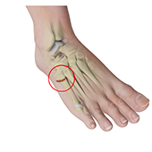 Jones Fracture Surgery