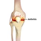 Knee Arthritis