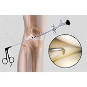 Knee Arthroscopy