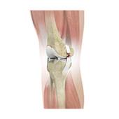 Knee Ligament Injuries