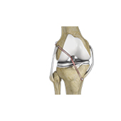 Knee Ligament Reconstruction