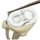 Meniscectomy