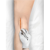 Minimally Invasive Knee Replacement