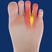 Morton's Neuroma