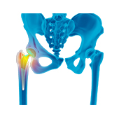 Revision Hip Replacement