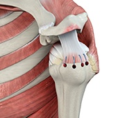 Rotator Cuff Repair