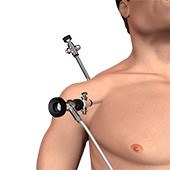 Shoulder Arthroscopy