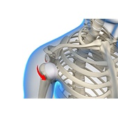 Shoulder Instability