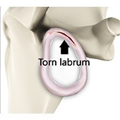 Shoulder Labral Tear