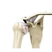 Shoulder Ligament Injuries