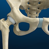 Stress Fractures of the Hip
