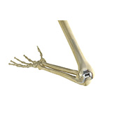 Total Elbow Replacement