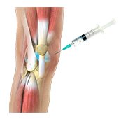 Viscosupplementation