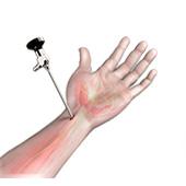 Wrist Arthroscopy