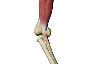 Distal Biceps Avulsion
