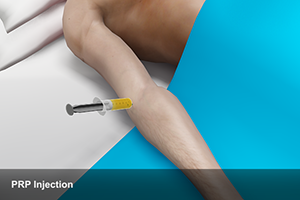 Platelet-Rich Plasma (PRP) Injection