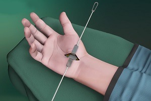 Hand Fracture surgery