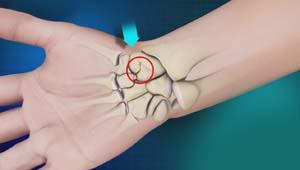 Scaphoid fracture