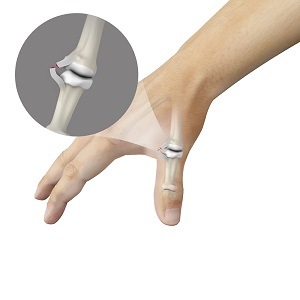 Skier’s Thumb