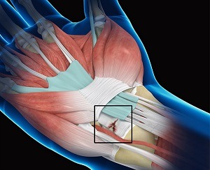 Wrist Ligament Tear and Instability