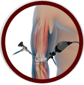 Elbow Arthroscopy