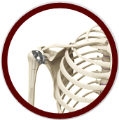 Total Shoulder Arthroplasty