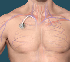 Port-a-Cath for Chemotherapy