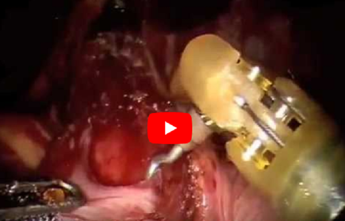da Vinci Heller Myotomy