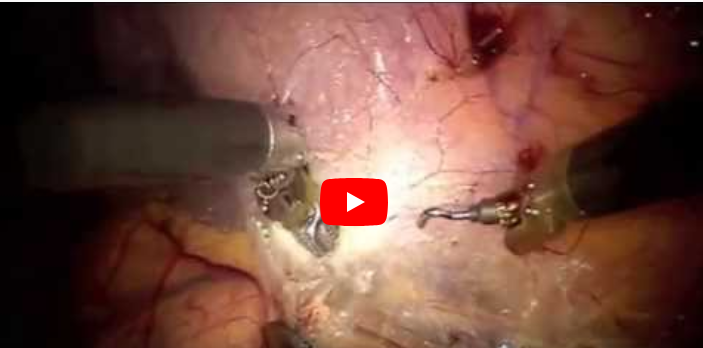 daVinci Left Adrenalectomy