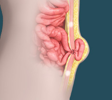 Hernia Repair