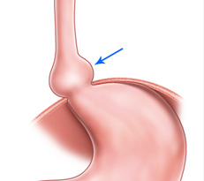 Hiatal Hernia and Heartburn