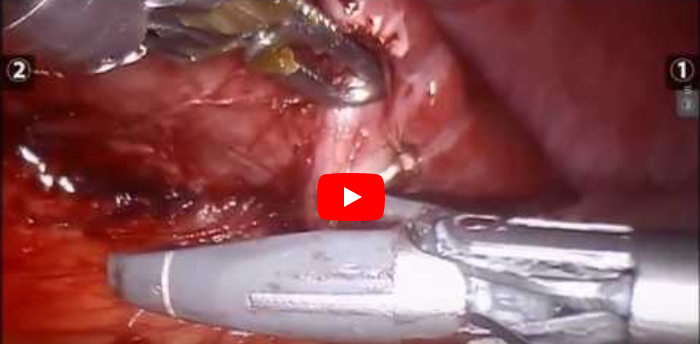 Robotic Splenectomy