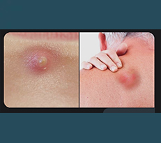 Skin Lumps and Cysts