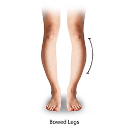 Bowed Legs