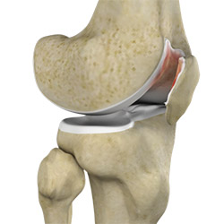 Chondromalacia Patella