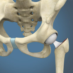 Hip Hemiarthroplasty