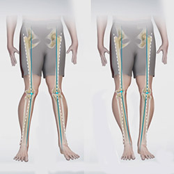 Knee Angular Deformities