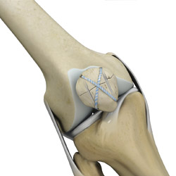Knee Fracture Surgery